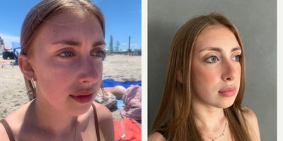 45-54 year old woman treated with Rhinoplasty - Rhinoplasty - Virtual consultation, real surgery!!