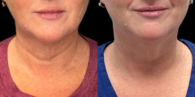 45-54 year old woman treated with Morpheus8, Microneedling RF, Skin Tightening, Skin Rejuvenation - Morpheus8 Face and Neck before and after by VIPS Cosmetic Center in Port St. Lucie, FL. This female patient completed a series of Morpheus8 RF microneedling treatments to the face and neck to address skin laxity, jowling, submental fullness, and overall skin texture. Her results show improved jawline definition, a smoother lower face and neck contour, reduced fullness under the chin, and a tighter, more rejuvenated appearance.