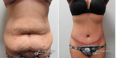 25-34 year old woman treated with Tummy Tuck - 6 months after tummy tuck