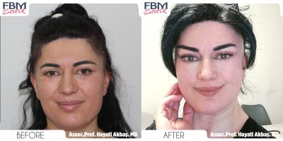 35-44 year old woman treated with SMAS Facelift, Facial Fat Transfer, Eyelid Surgery - 35-44 year old woman treated with SMAS Facelift, Facial Fat Transfer