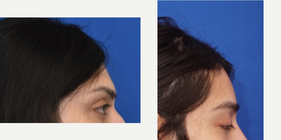 25-34 year old woman treated with Facial Feminization Surgery - A type 3 brow bone reduction and forehead contouring performed by Dr. Jeff Jumaily. The patient appears much more feminine and very happy with the results.
