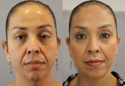 35-44 year old woman treated with Profound RF - 35-44 year old woman treated with Profound RFPatient was concerned mild skin laxity on lower face and neck as well as eyelid asymmetry. Patient is 4 months post operative Profound RF, Bilateral Upper Lid Blepharoplasty with Ptosis Repair (left eye) and injectable therapies.