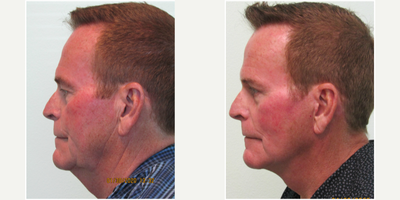 60+ year old man treated with Facelift - This active male presented with the concerns of significant loss of his profile due to a turkey neck.  He also wished to improve his jawline with better definition and skin tone.  He stated that he was quite consistent with his skin care routine (including retin-a), but the sagging skin continued to worsen over time.We agree together to perform a lower facelift and necklift under local anesthesia in our Center.  He was administered oral valium prior to his procedure in order to alleviate his anxiety.  The procedure time was slightly more than 2 hours and most of his sutures were removed after one week.  He was able to return to physical activity at two weeks.His results demonstrate improved profile and jawline definition while maintaining a natural non-operated look.