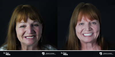 45-54 year old woman treated with All-on-4 Dental Implants, Dental Implants - zygomatic implants