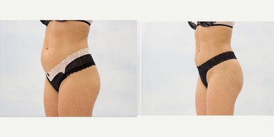 43 year old woman, Laser Liposuction for abdomen and waist + fat transfer to buttocks. - Liposuction LipoLife - laser, for abdomen and waist. Fat transfer to buttocks (2x200 ml).
 Second picture 2 weeks after the procedure.
Patient was aware that limited fat amount would allow us to do only little correction. She wanted to make buttocks just a bit more rounded.&nbsp; Patient's garment size before: UK 8, USA XS (4), EUR 36.