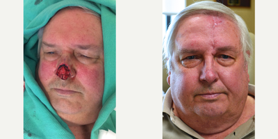 65-74 year old man treated with Facial Reconstructive Surgery - 65 year old male received a MOHs Repair to the nose; photos depict the patient's results 4 months post-op.