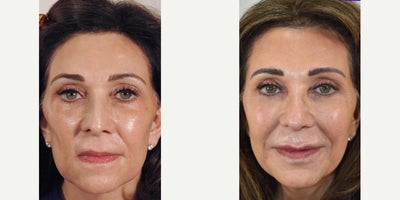 Sculptra Photos of Female Los Angeles Sculptra patient before and after photos - Patient photos were taken a full 8 years apart.  She has Dysport and Sculptra, but Sculptra is doing most of the work.