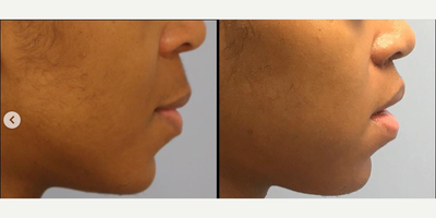 Woman treated with Lip Lift - This patient was looking to have a more feminine look to her face. I did a 10mm excision of skin to elevate the lip and make for a more delicate and feminine appearance. A surgical lip lift is a quick procedure that can be a powerful tool to bypass the need for lip fillers for patients who dont want to have to come in twice a year for injectible treatments.