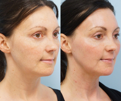 35-44 year old woman treated with Voluma - Voluma injection to highlight the cheekbone to enhance the Ogee curve which is most evident on an oblique view.  Notice the more anterior projection and volumization of the apple of her cheeks.