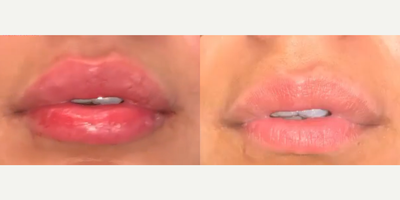 Woman treated with Lip Fillers, Restylane - Our patient wanted greater volume and definition of her upper lip. Restylane was used to enhance and define the upper lip to provide balance and contour. Patient is shown immediately following injection.