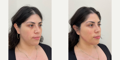 25-34 year old woman treated with Dermal Fillers, Botox for Gummy Smile, Brow Lift, Daxxify, Chin Filler, Cheek Lift, Lower Face - Jaw contour and chin filler.