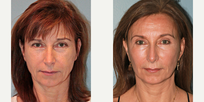 55-64 year old woman treated with Blue Peel - This patient underwent a blue peel, LiteLift, upper and lower eyelids, and fat transfer to cheeks. She had little bruising or swelling at 3 weeks post-op, which is one of the many benefits of our LiteLift facelift procedure. Results are also very natural as you can see in her pictures. After photos were taken 9 months post-op.