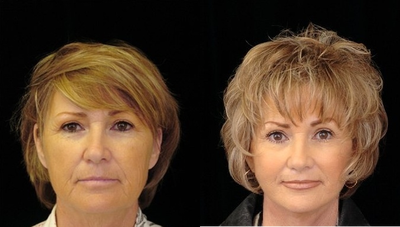 QuickLift - This patient received a QuickLift&trade;.