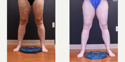 35-44 year old woman treated with EVLT, Sclerotherapy - Patient had EVLT performed and ultrasound guided sclerotherapy treatments for varicose veins.