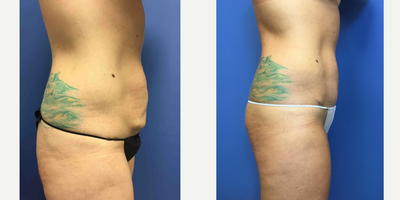 34 year old woman treated with Mini Tummy Tuck, liposuction and an umbilical float - She had a mini tummy tuck with liposuction and an umbilical float. This means that there is no incision around her belly button.
