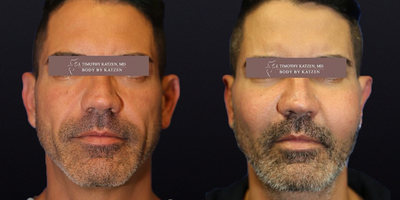 Woman treated with Cheek Augmentation - Procedure: Cheek ImplantsProcedure time: 1+ hoursForm of anesthesia: General anesthesiaDrains: NoneRecovery to return to sitting type job: 1-2 weeksRecovery to return to very active type job: 2-3 weeksReturn to limited activity: 2-3 weeksReturn to full activity: 3-4 weeksCost: depends on your plastic surgeon