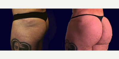 Man treated with Brazilian Butt Lift - Procedure: Fat Transfer to the ButtocksProcedure time: 2+ hours, depending on the area of liposuctionAnesthesia: General anesthesiaDrains: NoneRecovery for sitting type job: 2-3 weeksRecovery for very active job: 2-3 weeksLimited activity return: 2-3 weeksFull activity return: 3-4 weeks