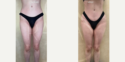 Woman treated with Hip Augmentation - Woman treated with Hip Augmentation