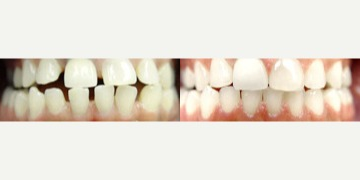 18-24 year old woman treated with Braces - Correction of spacing with braces