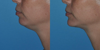 35-44 year old woman treated with Lipodissolve - Before and after Kybella injection for double chin.