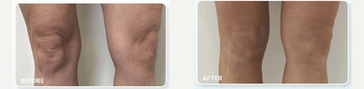 45-54 year old woman treated with Plasma IQ - 45-54 year old woman treated with Plasma IQ