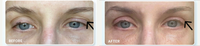 35-44 year old woman treated with Plasma IQ - 35-44 year old woman treated with Plasma IQ