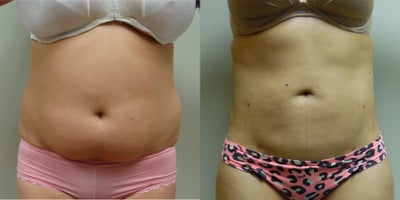 Laser Liposuction of the abdomen and love handles - Young woman who was concerned about her tummy and love handles. She was treated with Laser liposuction with &nbsp;resutls that gave her a flat tummy and great shape.