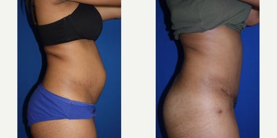 Tummy Tuck - Mother of one, who had her muscles ruined by pregnancy. They did not shrink back to normal. Pt just wanted to feel more normal again. pt was unhappy with all the stretch marks as well. Pt got a tummy tuck.