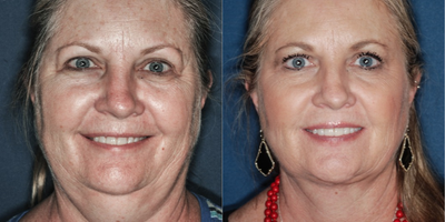 55-64 year old woman treated with Chin Liposuction - Procedure done with local anesthesia, in office, with minimal recovery time.