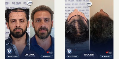 45-54 year old man treated with DHI Hair Transplant - A total of 4000 grafts were transplanted using the DHI technique.The implantation was focused on the frontal and mid-scalp areas, with approximately 2300 grafts placed in the frontal zone and the remaining grafts distributed across the mid-scalp for balanced density.