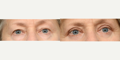 65-74 year old woman treated with Eyelid Surgery, Double Eyelid Surgery - This 66-year-old patient came to Dr. Wise to remove excess skin that weighed down her eyelids, and to remove under-eye puffiness. 2 months after her upper and lower blepharoplasty procedure, she is loving how awake and alert she now looks.