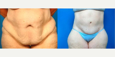 Woman treated with Body Lift - Woman treated with Body Lift.