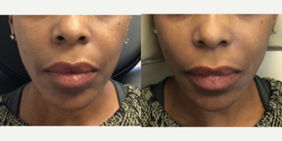 45-54 year old woman treated with Contour Thread Lift - 49 y.o. female - received molded PDO threads (18 g) one on each side. Immediate pull and slimmer shape.