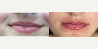 Woman treated with CoolPeel - Do you suffer from dry cracked lips? Girl, us too! Come and try out the CoolPeel for lips and get exfoliated plump lips that feel amazing. The lips feel rough for 1-3 days as the micro dots you see called MENDS slowly slough off. No actualpeeling will occur despite the laser name, but the lips are exfoliated by this treatment and collagen is stimulated in the process.