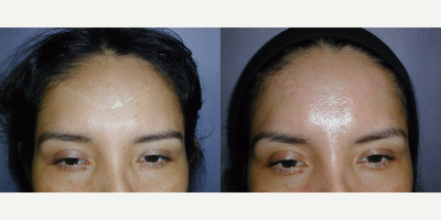 25-34 year old woman treated with Scar Removal - 34 year old female with revision of forehead scar using multiple z-plasties.