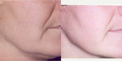 35-44 year old woman treated with TITAN - Skin Tightening of nasal labial folds and oral commissures