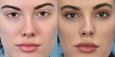 18-24 year old woman treated with Facial Fat Transfer - 18-24 year old woman treated with Facial Fat Transfer
