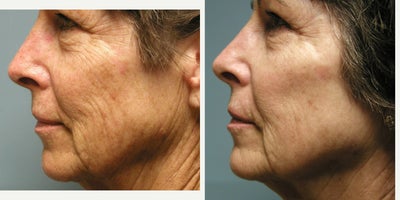 65-74 year old woman treated with CO2 Laser - Patient had fractionated CO2 laser, Total FX, in office