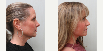 35-44 year old woman treated with Facelift, Brow Lift, Facial Fat Transfer - This patient underwent a Facelift, Endoscopic Browlift with an Anterior hairline incision and fat transfer to multiple areas of the face.