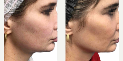 25-34 year old woman treated with Thermage FLX - After just one Thermage FLX lower face treatment, this patient saw improvement in the definition of her jawline and overall skin tightening. Results will improve more overtime and with additional treatments.