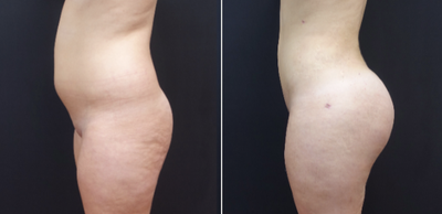 18-24 year old woman treated with Brazilian Butt Lift Revision - The patient underwent a Brazilian Butt Lift (fat transfer for butt augmentation). The combination of the liposculpting and the fat transfer transformed her from square to an hourglass figure.