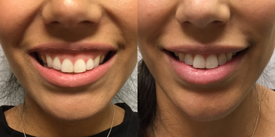 27 year old woman treated with Botox for a gummy smile. - This 27 year old was bothered by her gummy smile. Her results from treatment with Botox are seen in this after photo, taken 2 weeks after injections.