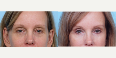 35-44 year old woman treated with Ear Surgery - This patient is her 40s was bothered that she was looking more tired and aged in her eyes. She had an upper eyelid lift, lower eyelid lift with fat transposition and a lower eyelid chemical peel to treat the fine lines of her lower eyelids. Note how the excess skin of the upper eyelid is gone, the bags and wrinkles of the lower eyelids are better and she has maintained the natural shape of her eyes. Incisions of the lower eyelids are imperceptible.
