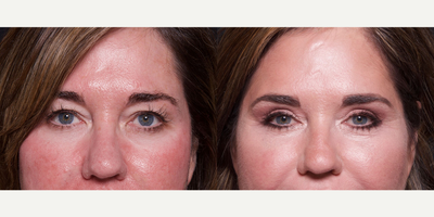 Woman treated with Eyelid Surgery - Woman treated with Eyelid Surgery