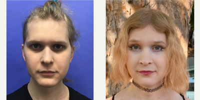 Patient treated with Cheek Augmentation, Facial Feminization Surgery, Rhinoplasty, Septoplasty, Transgender Facial Feminization  - 25 to 34 year-old female patient is 9 months post-op from Facial Feminization surgery. Her procedures included: Forehead Lift, Hairline Lowering, Orbital Bony Contouring, Septorhinoplasty (closed) with Cartilage Grafts and Radix Graft, Cheek Implants (small), Chin Reduction and Contour, Soft Tissue to Nasolabial Folds, Intranasal Lip Lift with Fascia to Lips, Thyroid Cartilage Shave and Voice Feminization, Periorbital TCA Peel and 300 Micrografts to Recessions.