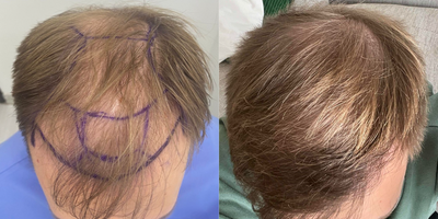 25-34 year old man treated with DHI Hair Transplant - diffuse thinning.DHI hairline implantations with 4.500 FU grefts.