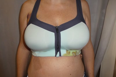 Breast Reduction and Lift 34GG to 34D - Review - RealSelf