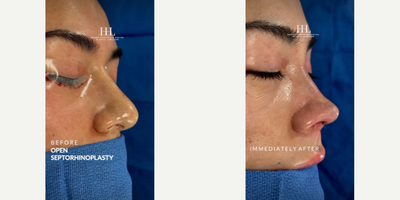 Woman treated with Revision Rhinoplasty - Woman treated with Revision Rhinoplasty through open Septoplasty with cartilage grafting to the nasal tip. Pre-op, patient is complaining of a bulbous nasal tip, and a strong nasal bridge. She desired a more refined nasal tip and a slight curve to the nasal bridge. Patient is shown before and immediately after the surgery.
