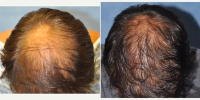 35-44 year old man treated with NeoGraft - Neograft Procedure: 2500 grafts