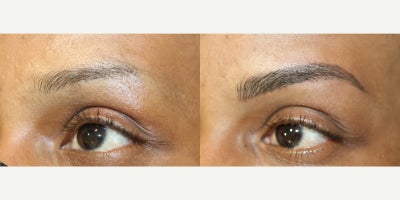 35-44 year old woman treated with Microblading, Permanent Makeup - Microblading is a precision-based form of cosmetic tattooing designed to enhance and restore natural brow shape. Each treatment is performed by Ruth Swissa, CMM, a leading expert in medical micropigmentation.Using a sterile, single-use microblade, ultra-fine pigment is deposited into the superficial dermis to create realistic, hair-like strokes that blend seamlessly with existing brow hair. Each procedure includes a detailed facial analysis and custom brow mapping to ensure symmetry, balance, and a tailored result.Ideal for patients with thinning brows, asymmetry, or hair loss, microblading delivers soft, natural-looking enhancement with results that continue to refine as the pigment settles. *A follow-up session is recommended to perfect the final outcome.